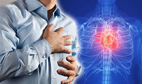 Heart attack keno hoy  A myocardial infarction ( MI ), commonly known as a heart attack, occurs when blood flow decreases or stops in one of the coronary arteries of the heart, causing infarction (tissue death) to the heart muscle